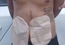 Ladrão com bolsas de colostomia rouba caminhonete de R$ 140 mil em MG Ladrão com bolsas de colostomia rouba caminhonete de R$ 140 mil em MG