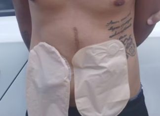 Ladrão com bolsas de colostomia rouba caminhonete de R$ 140 mil em MG Ladrão com bolsas de colostomia rouba caminhonete de R$ 140 mil em MG