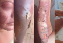 Gestante Sofre Ataque com Fogo em Prata Após Discussão; Suspeita Usou Gasolina Gestante Sofre Ataque com Fogo em Prata Após Discussão; Suspeita Usou Gasolina