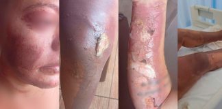 Gestante Sofre Ataque com Fogo em Prata Após Discussão; Suspeita Usou Gasolina Gestante Sofre Ataque com Fogo em Prata Após Discussão; Suspeita Usou Gasolina