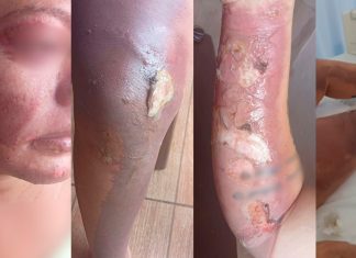 Gestante Sofre Ataque com Fogo em Prata Após Discussão; Suspeita Usou Gasolina Gestante Sofre Ataque com Fogo em Prata Após Discussão; Suspeita Usou Gasolina