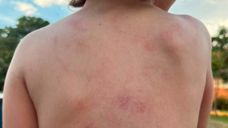 Mãe Relata Violência Contra Filho Autista na Apae de Ituiutaba